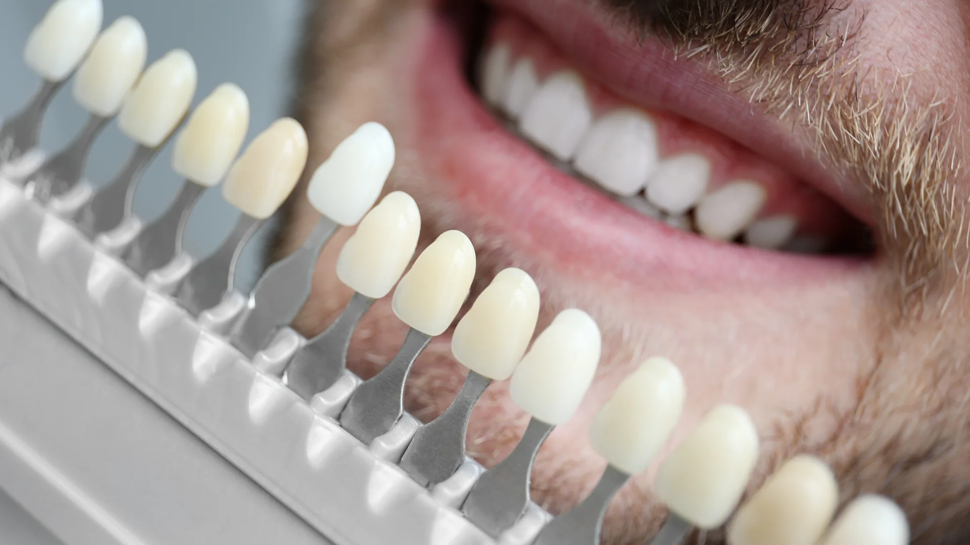 Sbiancamento dentale professionale: metodi, risultati e sicurezza