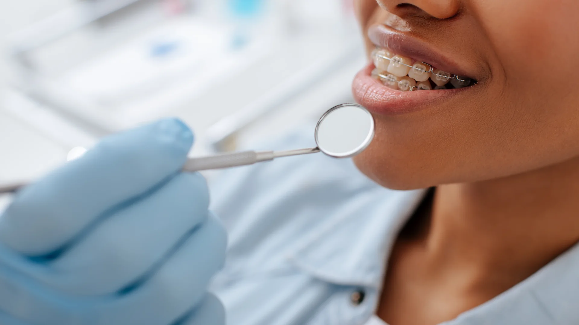 Aparat dentar pentru adulți: tipuri, durată și prețuri în 2026